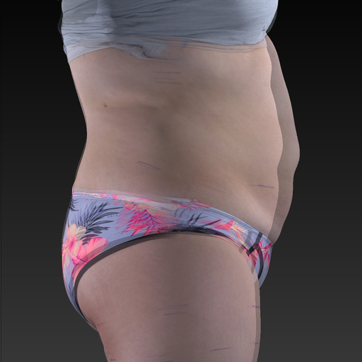 6 Sessions Fat Reduction Results